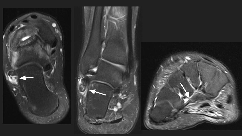 Figure 5 for case Charcot joint ( RID5075 )